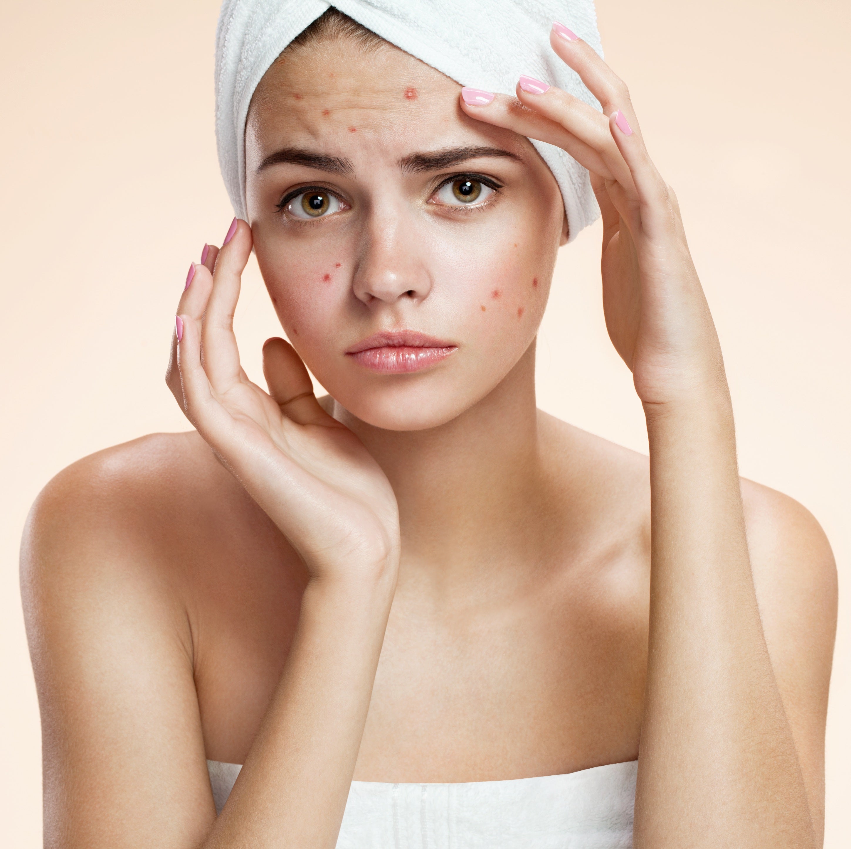 Pattanásos bőr kezelése 