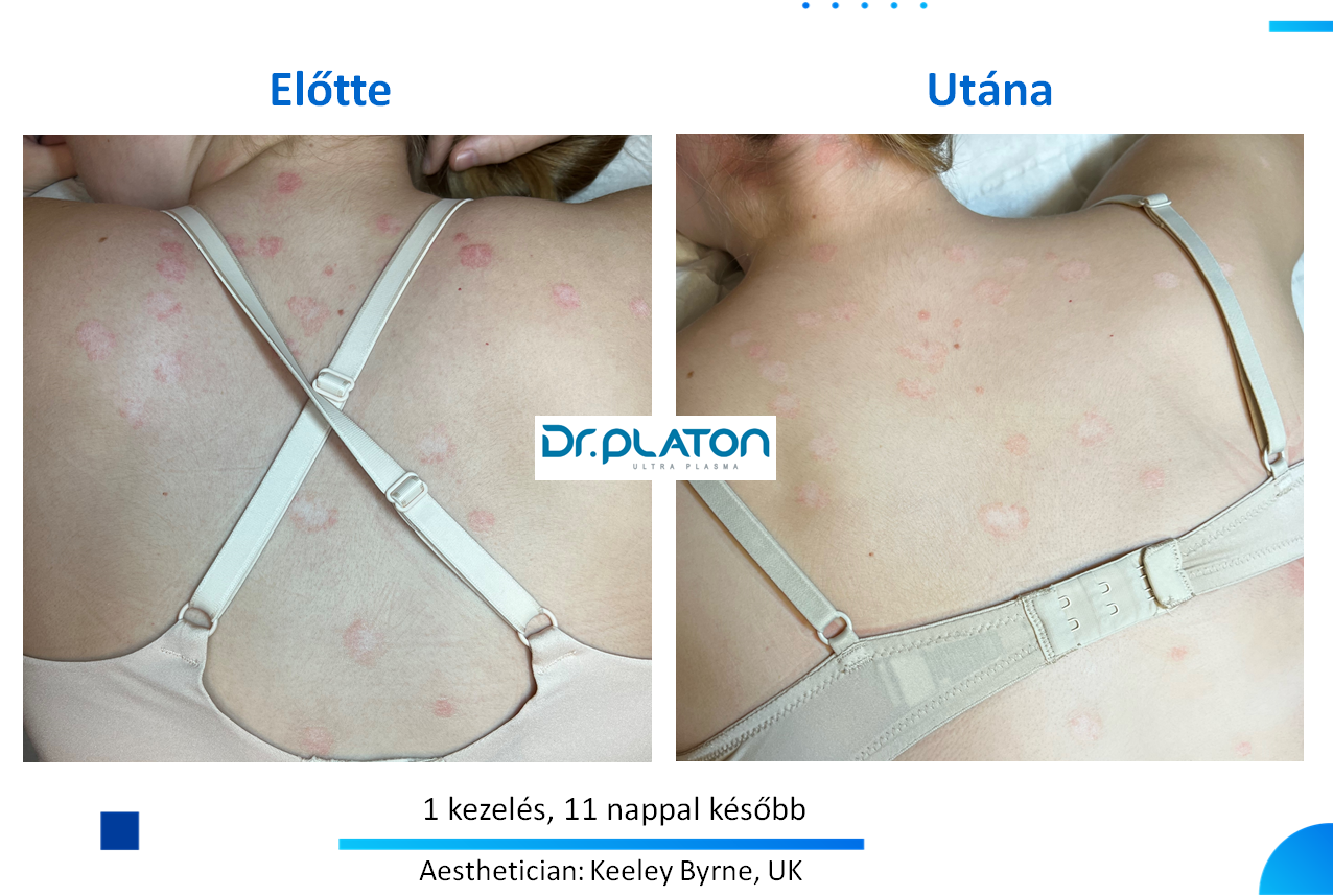 Dr. Platon hidegplazma